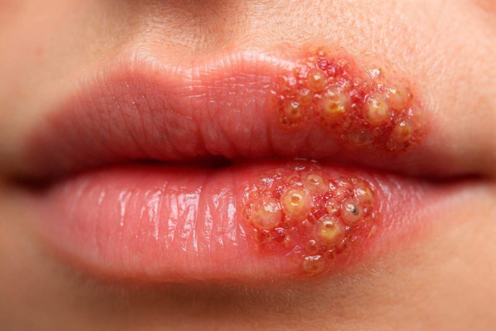 natural home remedies for herpes
